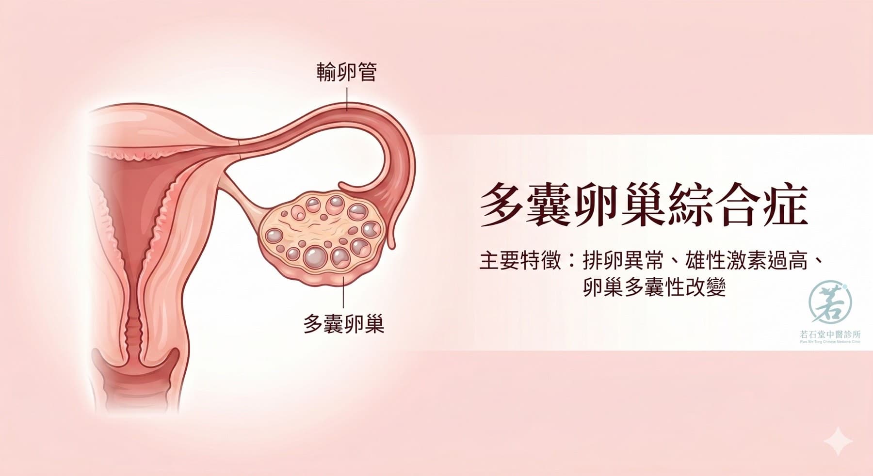 多囊卵巢綜合症 PCOS 示意圖,顯示排卵異常、雄性激素過高及卵巢多囊性改變