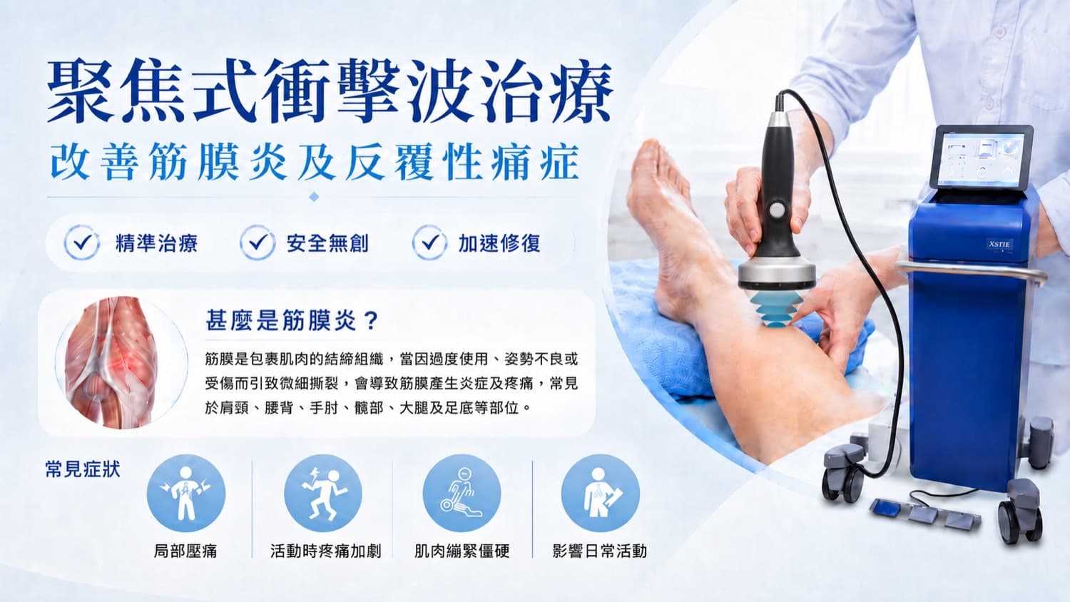 聚焦式衝擊波治療改善筋膜炎及反覆性痛症介紹